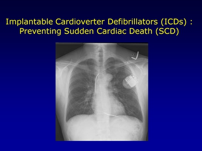 Implantable Cardioverter Defibrillators (ICDs): Preventing Sudden Cardiac Death (SCD)