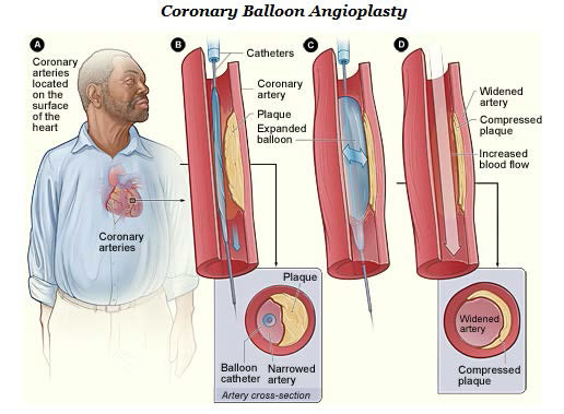 Drawing of coronary arteries and what happens to them during a coronary balloon angioplasty.