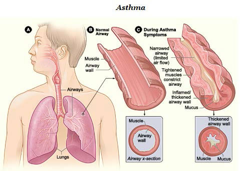 Drawing showing normal airway and airway during asthma symptoms.