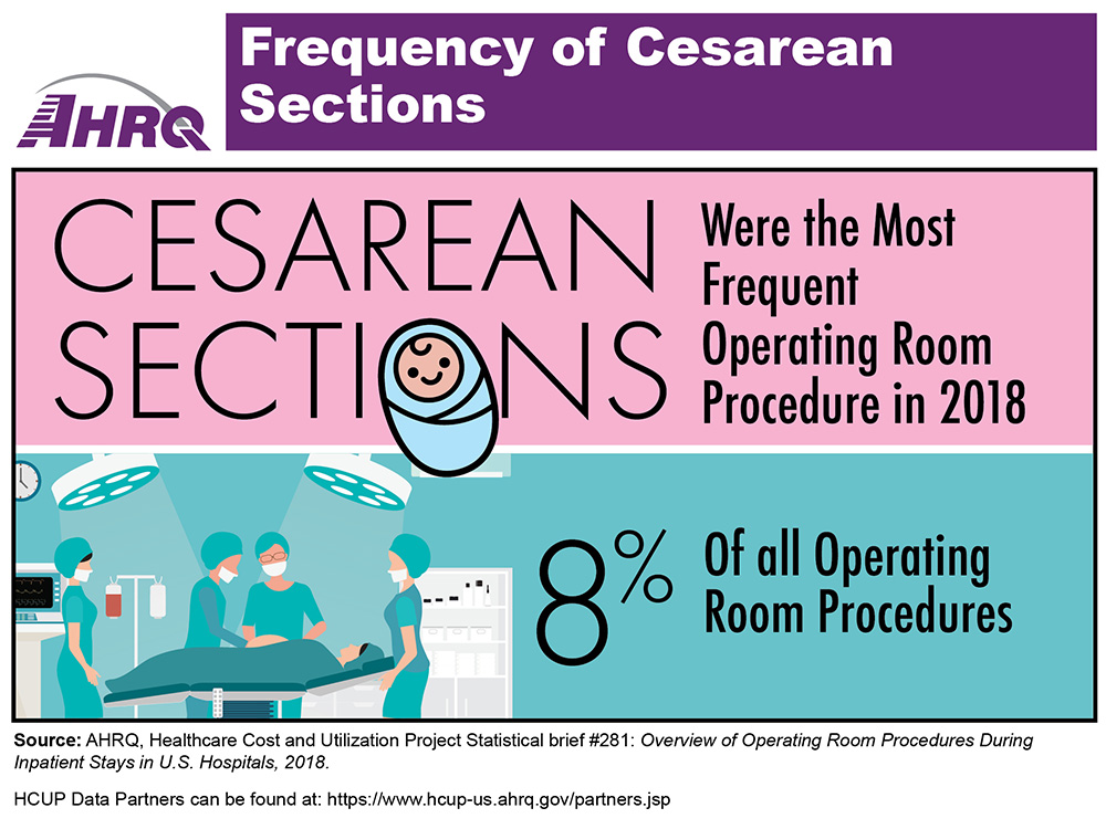 Infographic noting that cesarean sections were the most frequent operating room procedure in 2018, accounting for 8 percent of all operating room procedures. Includes a drawing of doctors in an operating room preparing for a cesarean section.