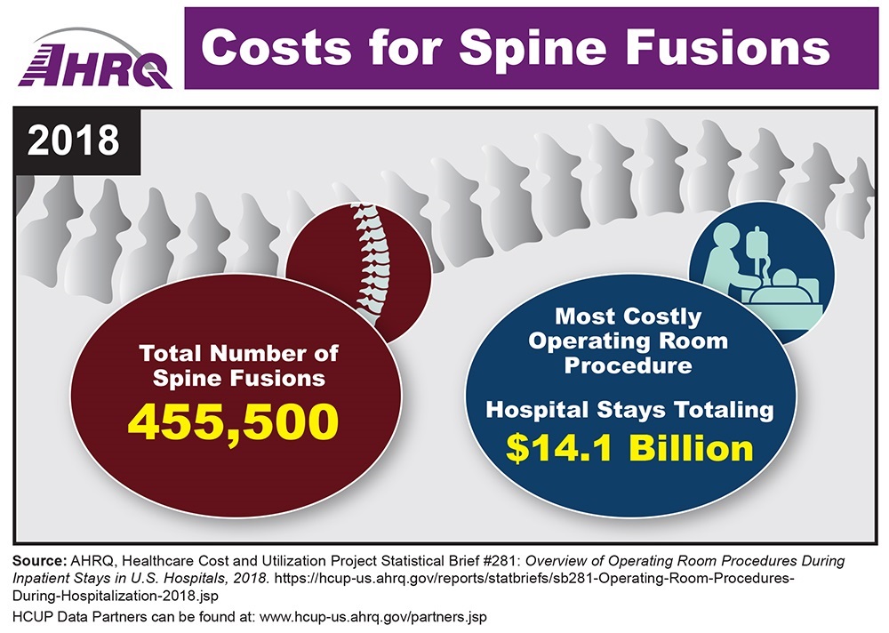 Infographic noting there were 455,500 spine fusions in 2018. It was the most costly operating room procedure, with hospital stays totaling $14.1 billion. Includes a diagram of vertebrae and drawing of a nurse by a patient’s hospital bed.