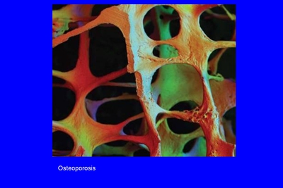 Image: A microphotograph shows a three-dimensional view of osteoporotic bone cells