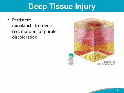 Deep Tissue Injury